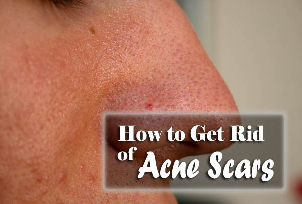 How to Get Rid of Acne Scars - Starsricha