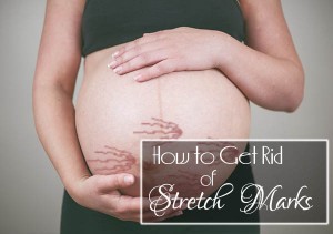 how-to-get-rid-of-stretch-marks