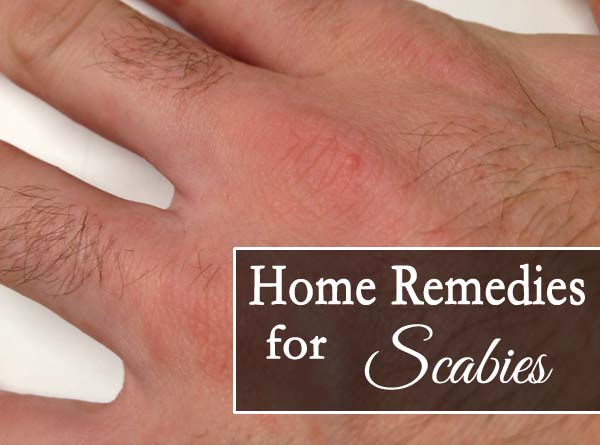 how to cure scabies at home